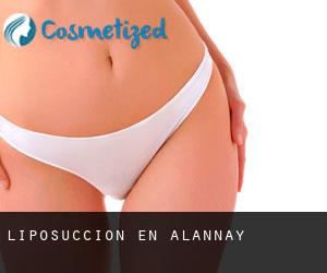Liposucción en Alannay