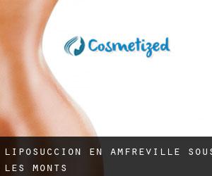 Liposucción en Amfreville-sous-les-Monts