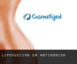 Liposucción en Antigonish