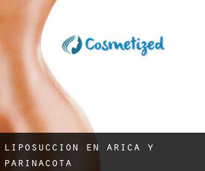 Liposucción en Arica y Parinacota