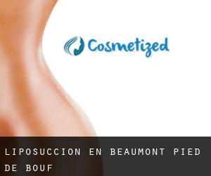 Liposucción en Beaumont-Pied-de-Bœuf