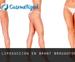 Liposucción en Brant Broughton