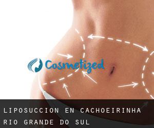 Liposucción en Cachoeirinha (Rio Grande do Sul)