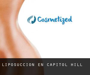 Liposucción en Capitol Hill