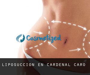 Liposucción en Cardenal Caro