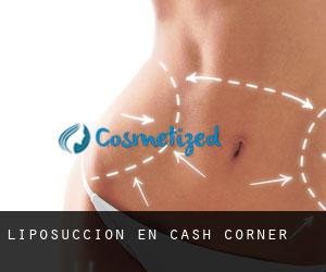 Liposucción en Cash Corner