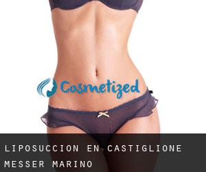 Liposucción en Castiglione Messer Marino