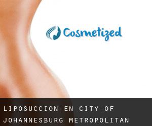 Liposucción en City of Johannesburg Metropolitan Municipality por ciudad - página 1