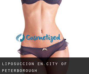 Liposucción en City of Peterborough