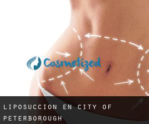 Liposucción en City of Peterborough
