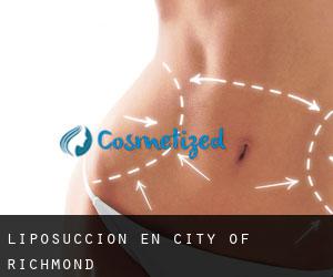 Liposucción en City of Richmond