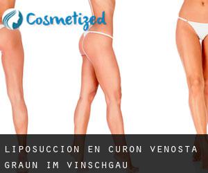 Liposucción en Curon Venosta - Graun im Vinschgau