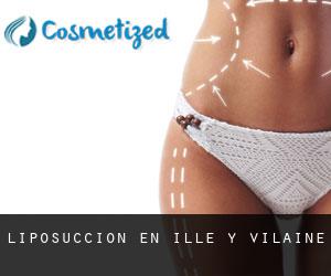 Liposucción en Ille y Vilaine Liposucción en Ille y Vilaine
