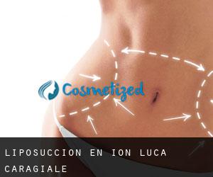 Liposucción en Ion Luca Caragiale