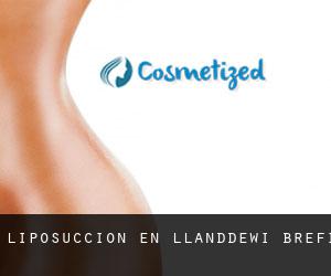 Liposucción en Llanddewi-Brefi