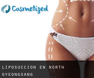Liposucción en North Gyeongsang