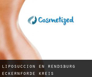 Liposucción en Rendsburg-Eckernförde Kreis