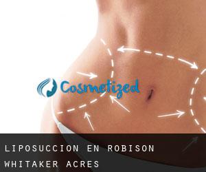 Liposucción en Robison-Whitaker Acres