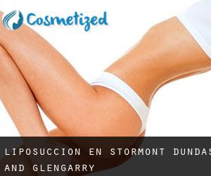 Liposucción en Stormont, Dundas and Glengarry