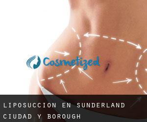 Liposucción en Sunderland (Ciudad y Borough)