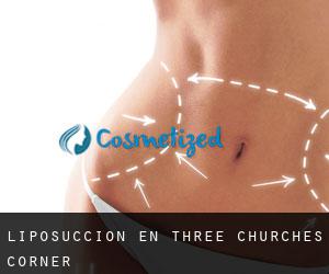 Liposucción en Three Churches Corner