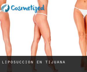Liposucción en Tijuana