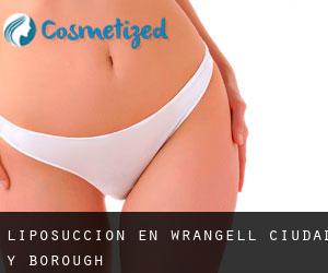 Liposucción en Wrangell (Ciudad y Borough)