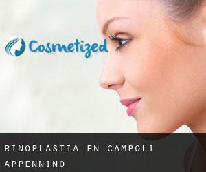 Rinoplastia en Campoli Appennino