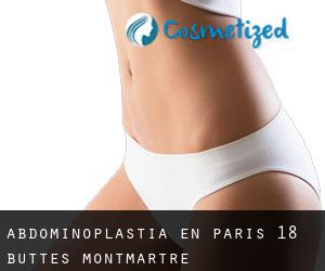 Abdominoplastia en Paris 18 Buttes-Montmartre
