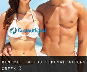Renewal Tattoo Removal (Aarons Creek) #3